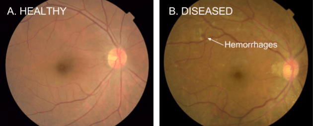 retinopathie-diabetique